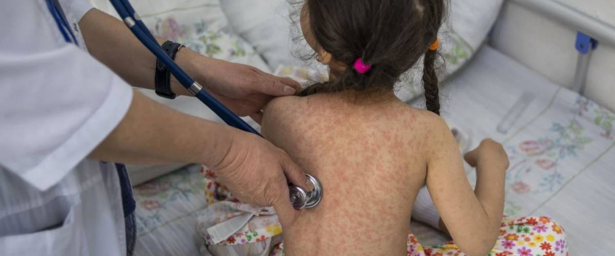 Fillette atteinte de rougeole en cours d’examen à l’hôpital clinique républicain des maladies infectieuses, dans la ville de Bichkek (Kirghizistan) - OMS/Danil Usmanov