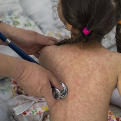 Fillette atteinte de rougeole en cours d’examen à l’hôpital clinique républicain des maladies infectieuses, dans la ville de Bichkek (Kirghizistan) - OMS/Danil Usmanov